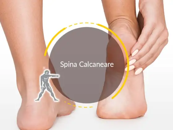 Sperone calcaneare e dolore al tallone - come capirlo e curarlo