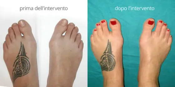 Tutore per alluce valgo, cosa cambia davvero tra prima e dopo