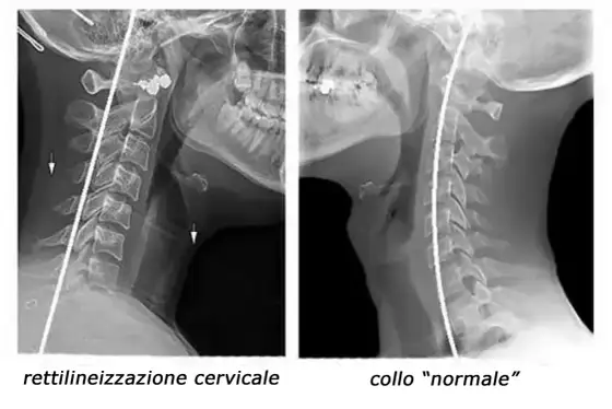 Rettilineizzazione del rachide cervicale, cosa significa davvero